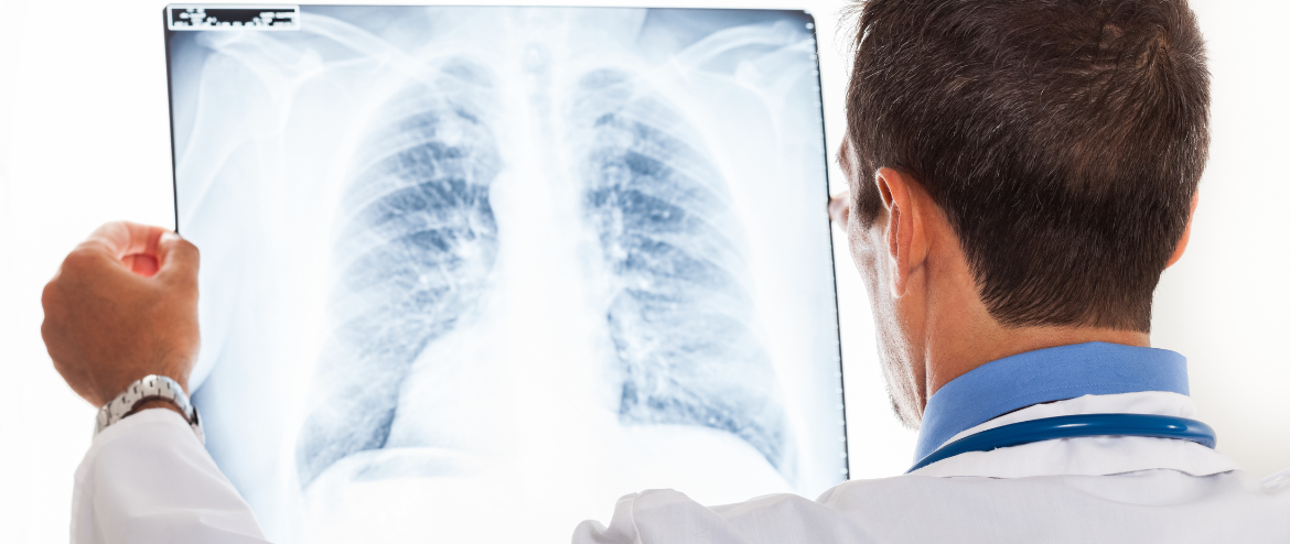 foto_blog_nódulos_pulmão.webp